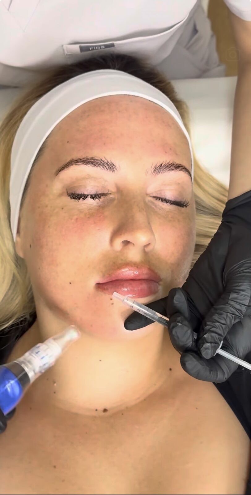 Dermal Fillers